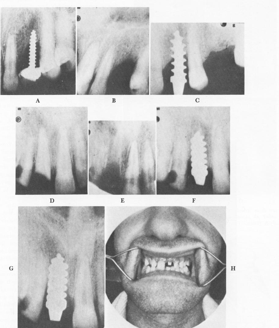 1 Removal of loose Strock endosseous implant from maxilla