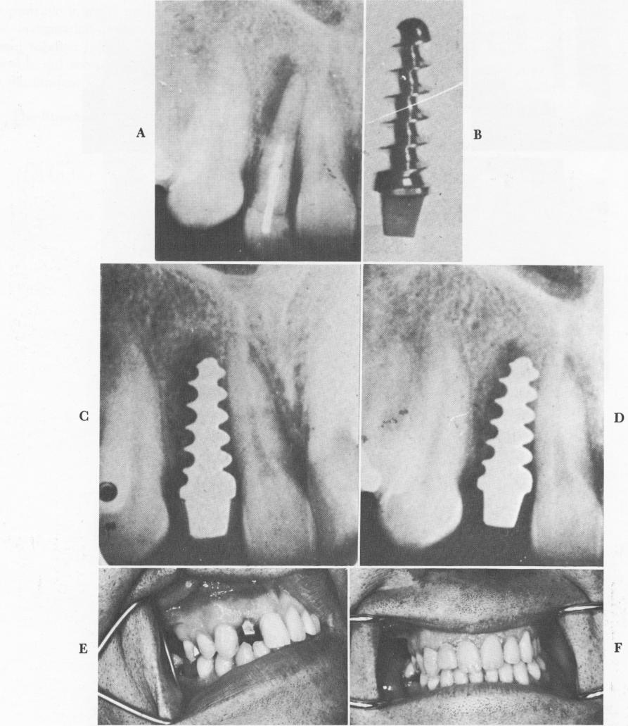 1 Strock endosseous implant placed in diseased site in maxilla