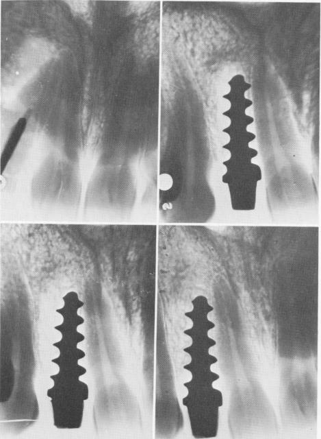 1 Strock`s endosseous implant replaces upper lateral tooth