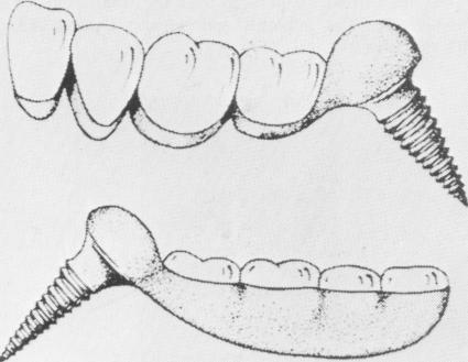 2 Dag`s endosseous implant design