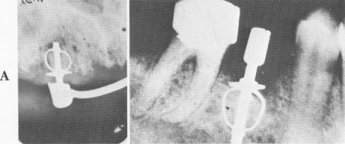 1 Bone growth around Lehman`s endosseous implant in maxilla and mandible