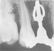 2 Soft tissues replace bone around Lehman`s endosseous implant post