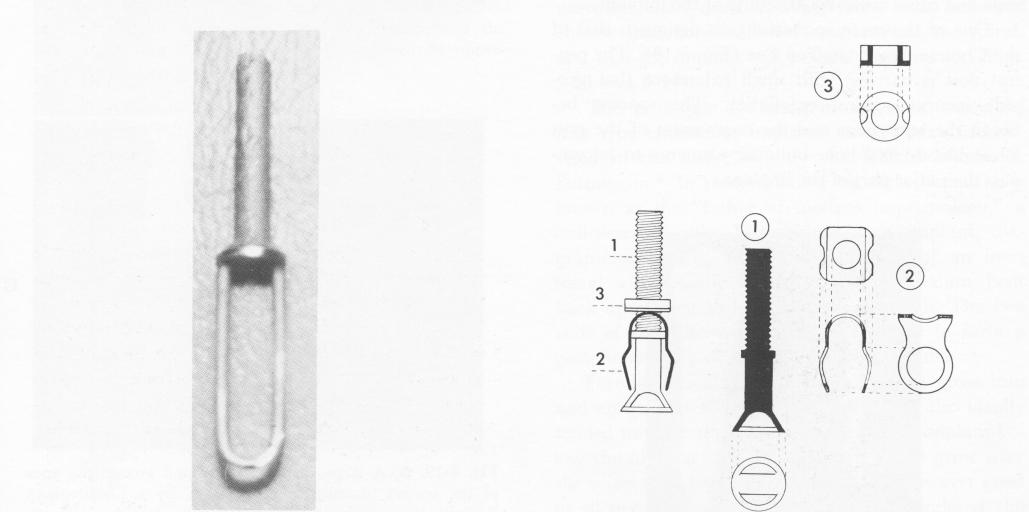 3 Pretto`s trombone endosseous implant design