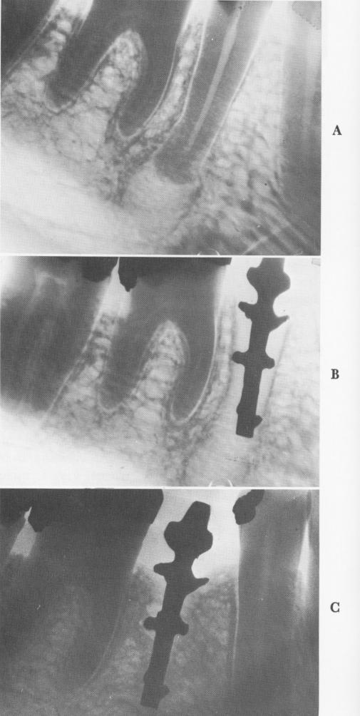 2 Extensions from Lee endosseous implant with same diameter as tooth