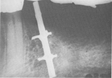 1 Bone growth observed up to Lee endosseous implant post