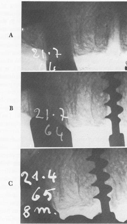 1 Tramonte endosseous implant successfully placed in an open socket
