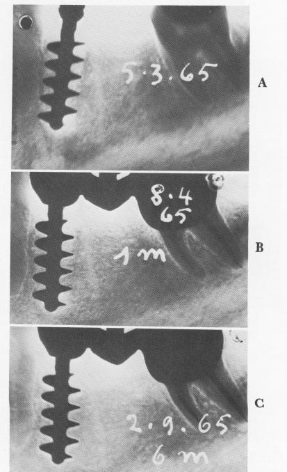 2 Tramonte endosseous implant fills socket and engages bone