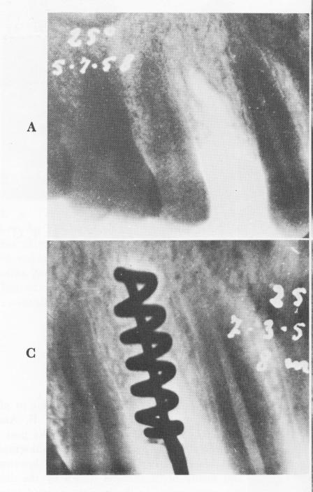 1 Soft tissue around spires of upper Formiggini endosseous implant