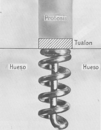 1 Perron-Andres endosseous implant with Ivalon casing around shaft
