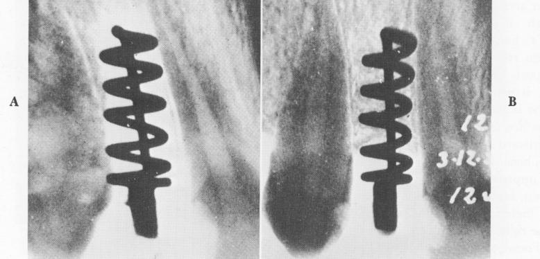 2 Bone growth through spirals of upper Perron Andres` endosseous implant