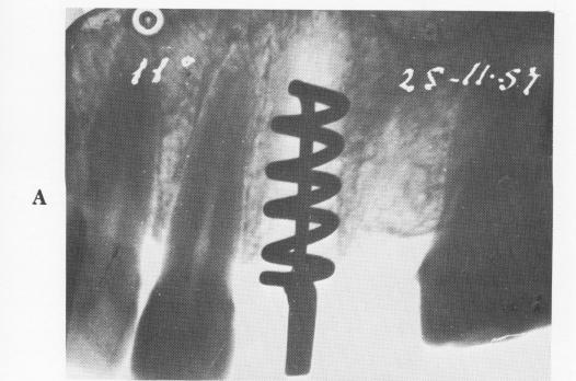 1 Perron-Andres endosseous implant inserted in open socket in maxilla