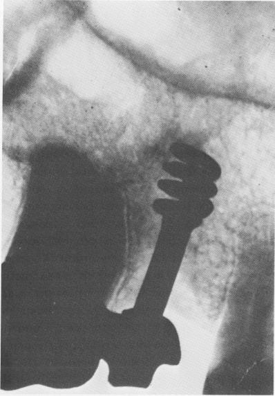 4 Chercheve`s early spiral endosseous implant in maxilla