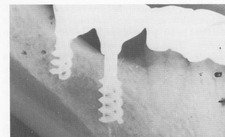 2 Double-helical cast vitallium Chercheve endosseous implant in mandible