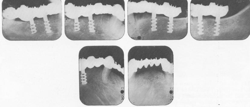 1 Muratori`s early endosseous implant inserted by Linkow in mandible
