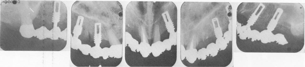 3 Bone regrowth around non self tapping endosseous vent plant implant 