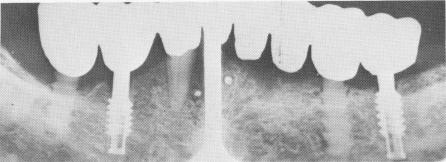 4 Vent-plants and sapphire endosseous implants in mandible
