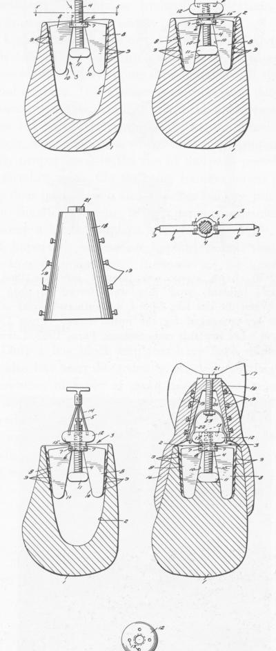 1 Irwin`s endosseous re exposed implant design