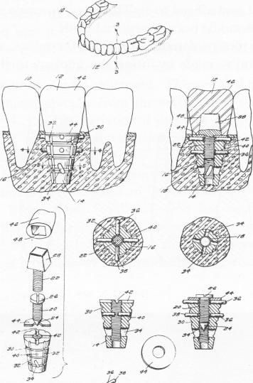 1 Screw inserted into base of Kiernan`s endosseous implant