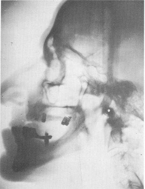 1 Raphael Chercheve`s endosseous spring implant design