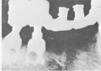 2 Benaim`s endosseous tubular implant is set on core of mandibular bone