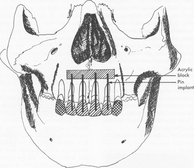 1 Chercheve upper endosseous pin implant from root canal to acrylic block