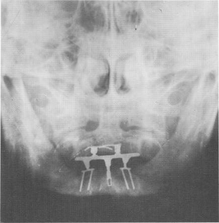2 Bordon and Azoulay bifid endosseous implant design