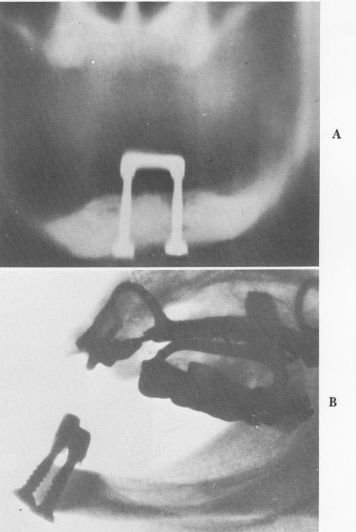 1 Vertical transfixation implant screws from mandible to alveolar crest