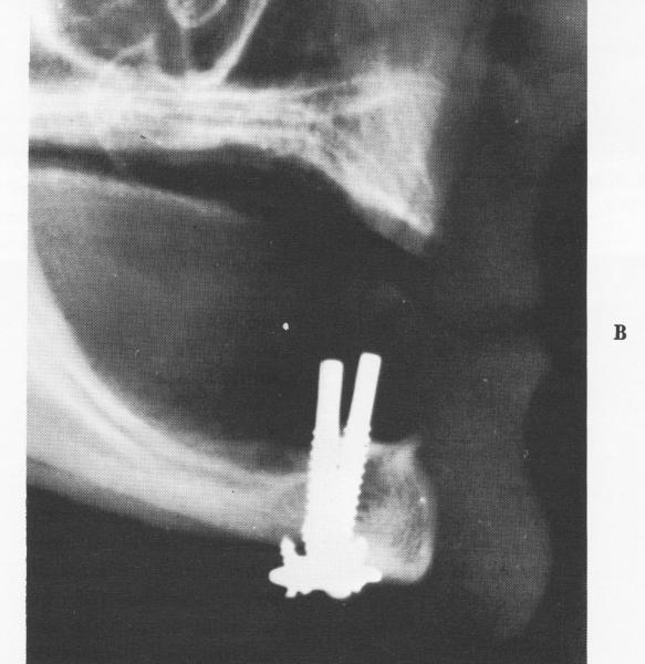 2 Lateral plate shows endosseous implant transfixation screws in place
