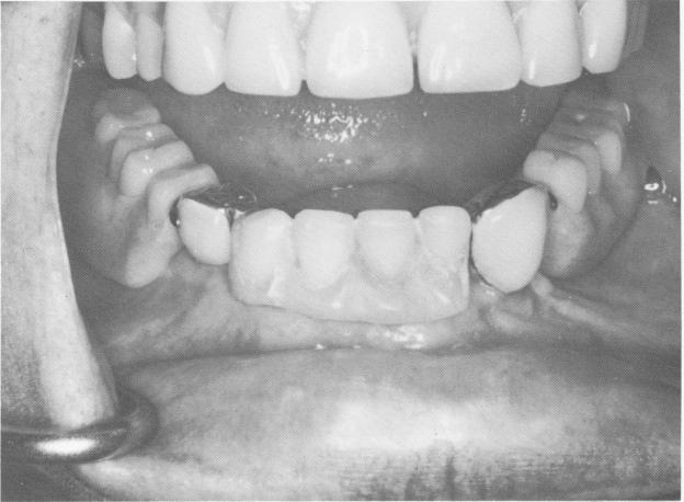 2 Denture is secured to endosseous implant abutments in mandible