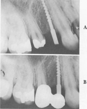 1 Linkow`s insertion of Chercheve narrow ridge upper endosseous implant