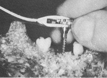 1 Guiding endosseous implant tap into position in mandible