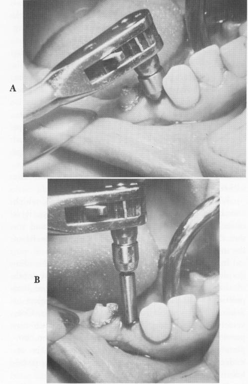 1 Prolongator raises endosseous implant ratchet head above lower teeth