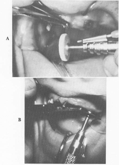 2 Length reduction of abutment post of endosseous implant post with disc
