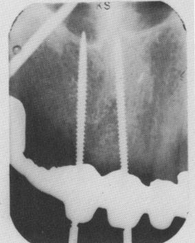 2 Radiograph of threaded endosseous pin implant