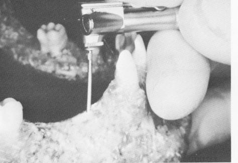 3 Insert endosseous pin implant with 10:1 reduction gear contra-angle