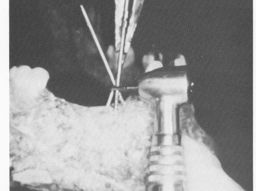 1 Endosseous pin implant held with pliers, length cut with fissure bur