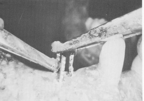 2 Head of endosseous pin implant is bent