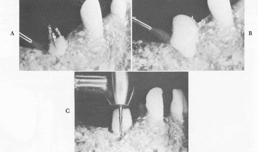 3 Acrylic resin core build up after lower endosseous pin implantation
