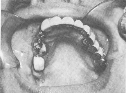 2 Basic instruments for endosseous blade implant surgery