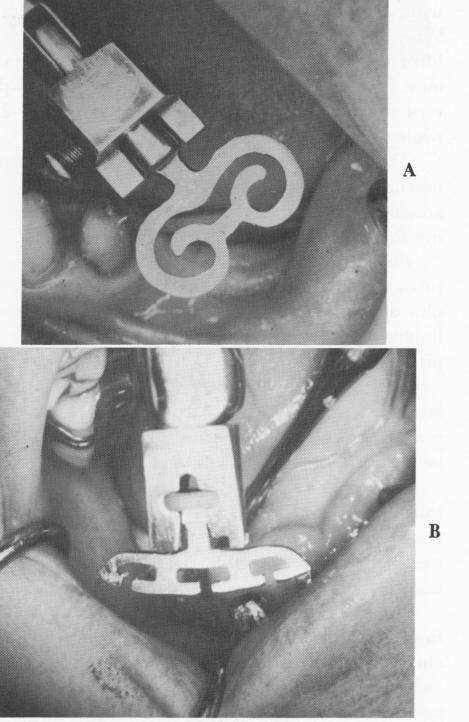 2 Endosseous blade held in mandible by screw and inserting ring