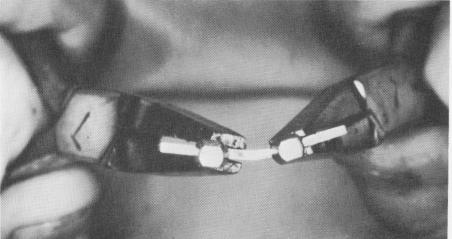 3 Two wide nosed pliers help bend endosseous blade implant to arch curve