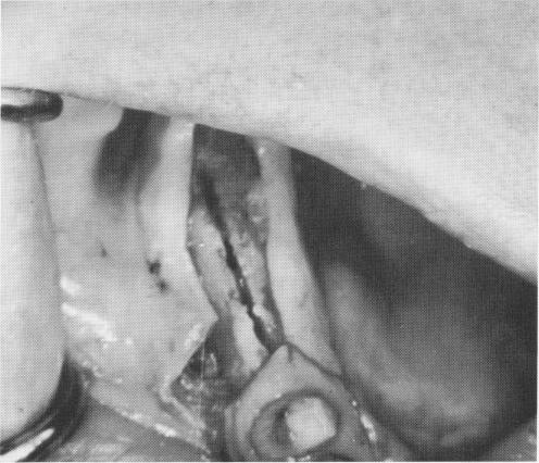 1 Endosseous blade implant groove must be narrow and clean