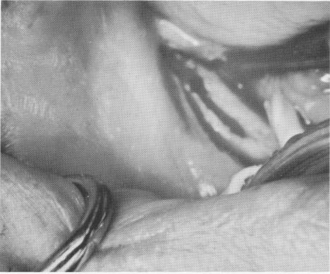 2 Wide groove reduces wedging of endosseous blade implant against bone