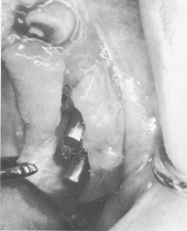 1 Thick tissues overly endosseous blade implant abutment posts