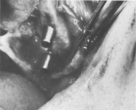 2 Thick tissues removed with scalpel, endosseous blade implant in place