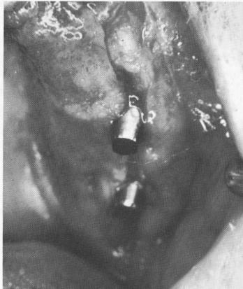3 Healing of thin tissues around endosseous blade implant site