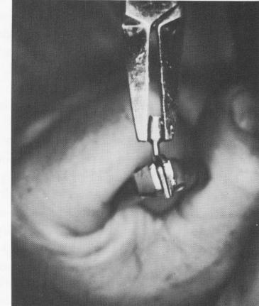 4 Endosseous blade implant post bent at neck for parallelism