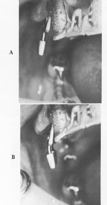 1 Endosseous blade implant post perpendicular to anterior occlusal plane