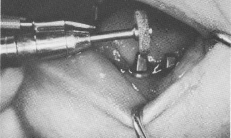 2 Heatless stone used to adjust endosseous blade implant occlusal height