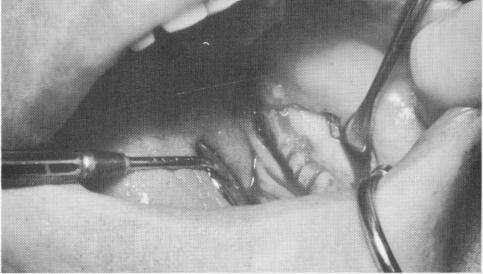 1 Smooth clean grooves for lingual fingers of subperiosteal implant